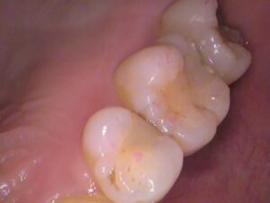 虫歯　セラミック　歯医者　自由が丘