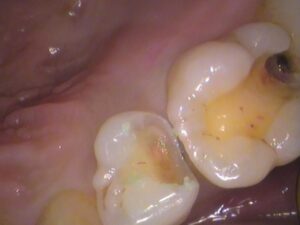 虫歯　セラミック　歯医者　自由が丘