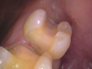 虫歯　セラミック　歯医者　自由が丘