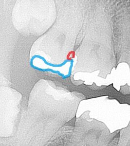 銀歯　虫歯　セラミック　自由が丘　歯医者