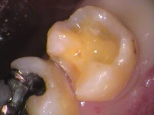 銀歯　虫歯　セラミック　自由が丘　歯医者
