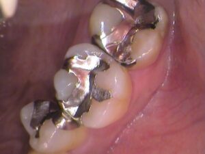 銀歯　虫歯　セラミック　自由が丘　歯医者