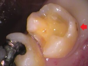 銀歯　虫歯　セラミック　自由が丘　歯医者