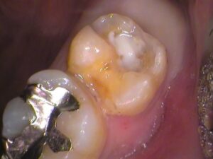 銀歯　虫歯　セラミック　自由が丘　歯医者