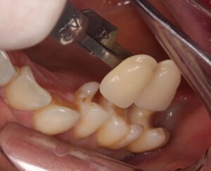 虫歯　セラミック　歯医者　自由が丘