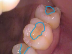 虫歯　セラミック　歯医者　自由が丘