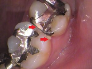 銀歯　虫歯　セラミック　自由が丘　歯医者
