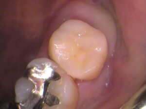銀歯　虫歯　セラミック　自由が丘　歯医者