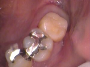 銀歯　虫歯　セラミック　自由が丘　歯医者