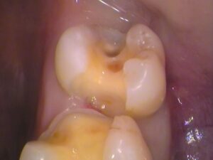 虫歯　セラミック　歯医者　自由が丘