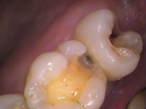 虫歯　セラミック　歯医者　自由が丘