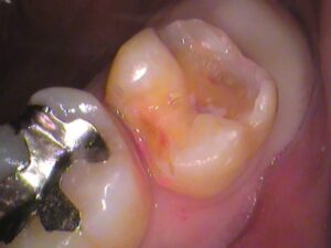 銀歯　虫歯　セラミック　自由が丘　歯医者