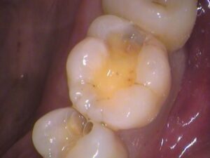 虫歯　セラミック　歯医者　自由が丘