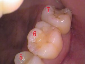 虫歯　セラミック　歯医者　自由が丘