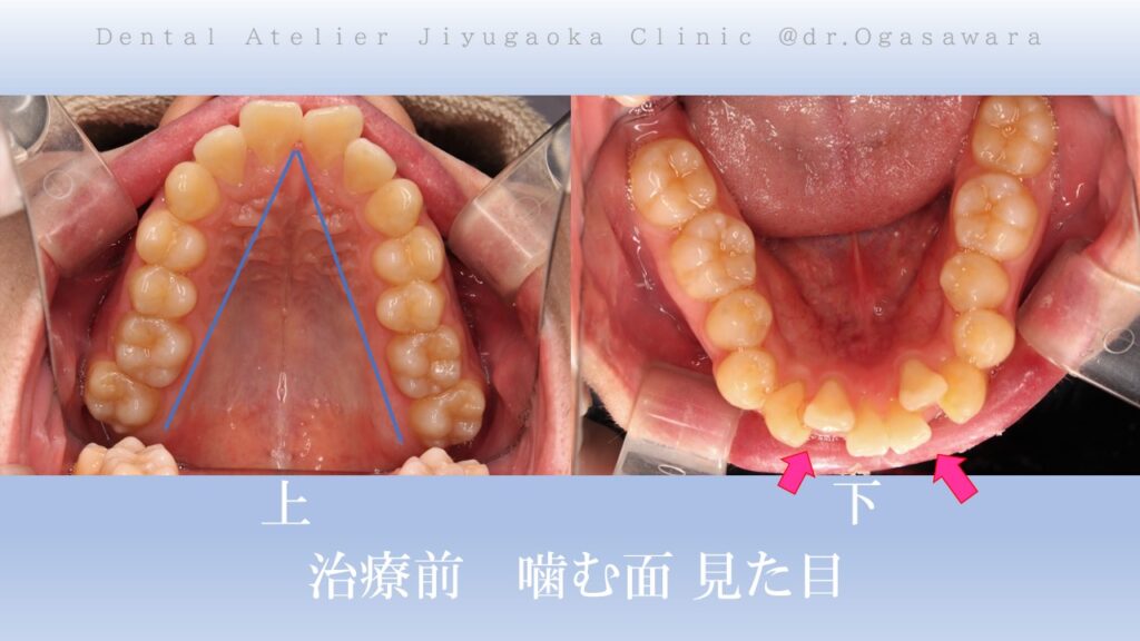 矯正　歯並び　出っ歯　ガタガタ　歯医者　自由が丘