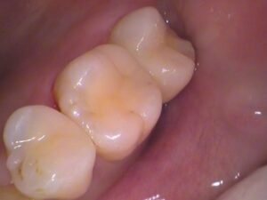 虫歯　セラミック　歯医者　自由が丘