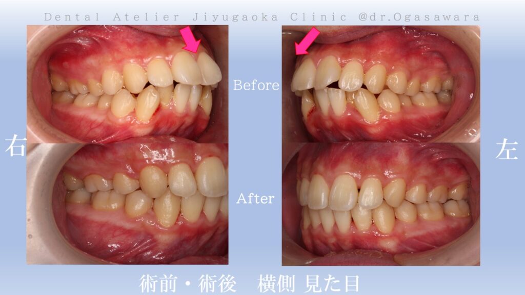 矯正　歯並び　出っ歯　ガタガタ　歯医者　自由が丘