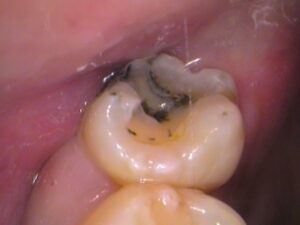 虫歯　分からない　セラミック　歯医者　自由が丘