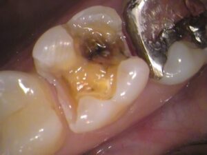 虫歯　銀歯　分からない　セラミック　歯医者　自由が丘