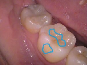虫歯　再発　分からない　セラミック　歯医者　自由が丘