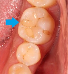 虫歯　着色　歯が黒い　歯医者　自由が丘