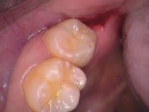 虫歯　分からない　セラミック　歯医者　自由が丘