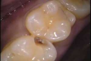 歯の間の虫歯　自由が丘　歯医者