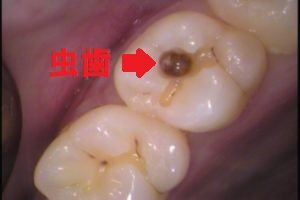 歯の構造　根管　根管治療　自由が丘　歯医者