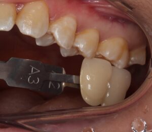 虫歯　分からない　セラミック　歯医者　自由が丘