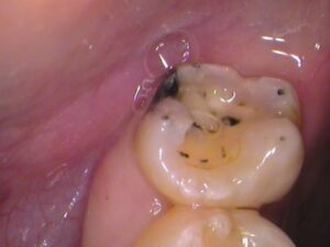 虫歯　分からない　セラミック　歯医者　自由が丘