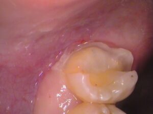 虫歯　分からない　セラミック　歯医者　自由が丘
