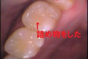 歯の構造　根管　根管治療　自由が丘　歯医者