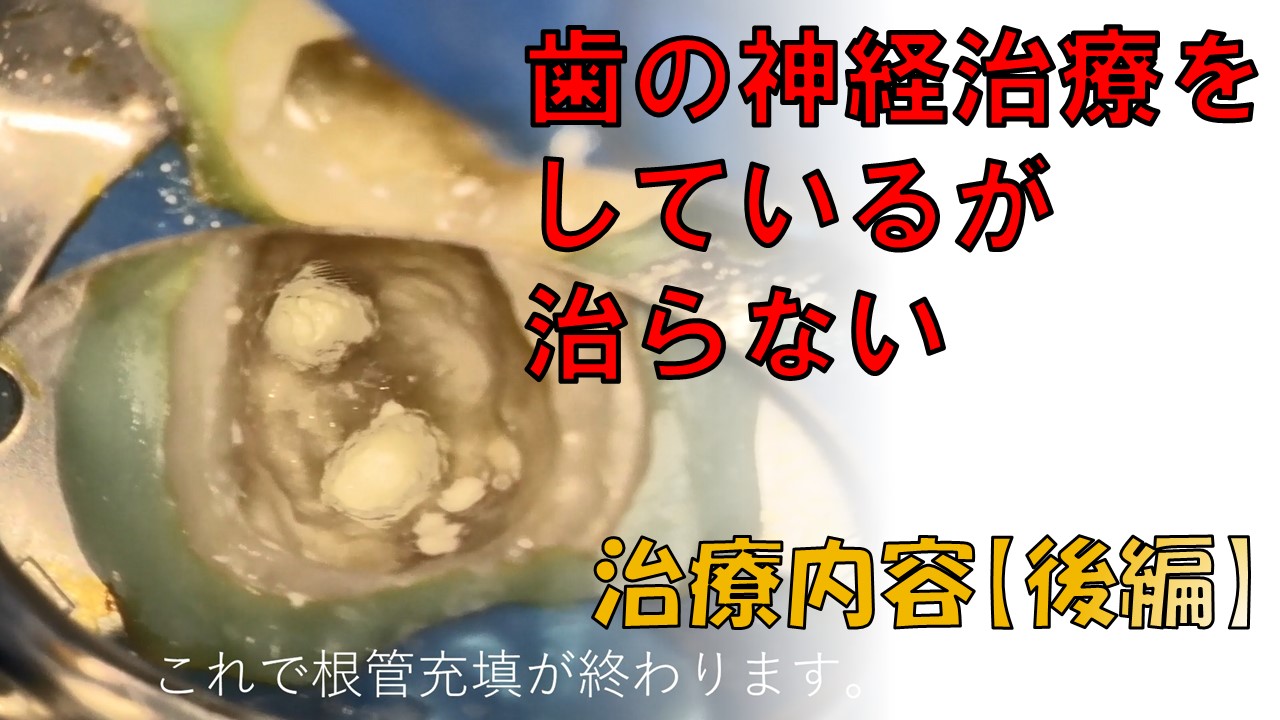 根管治療　根幹治療　マイクロエンド　自由が丘　歯医者