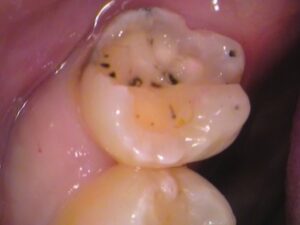 虫歯　分からない　セラミック　歯医者　自由が丘