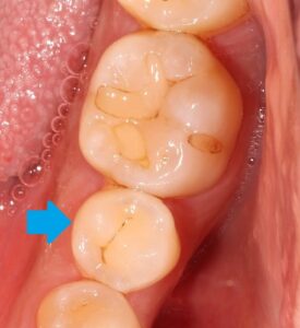 虫歯　着色　歯が黒い　歯医者　自由が丘