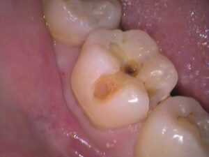 虫歯　再発　分からない　セラミック　歯医者　自由が丘