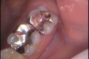 虫歯　銀歯　分からない　セラミック　歯医者　自由が丘