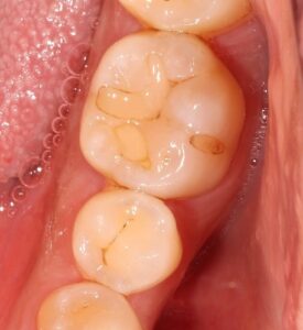 虫歯　着色　歯が黒い　歯医者　自由が丘