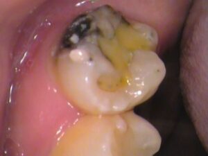 虫歯　分からない　セラミック　歯医者　自由が丘
