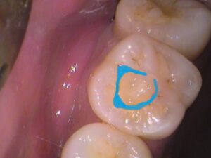 レジン　虫歯　セラミック治療　歯医者　自由が丘