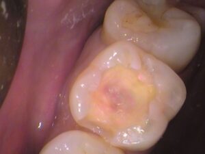 レジン　虫歯　セラミック治療　歯医者　自由が丘