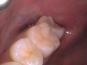 レジン　虫歯　セラミック治療　歯医者　自由が丘