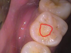 レジン　虫歯　セラミック治療　歯医者　自由が丘