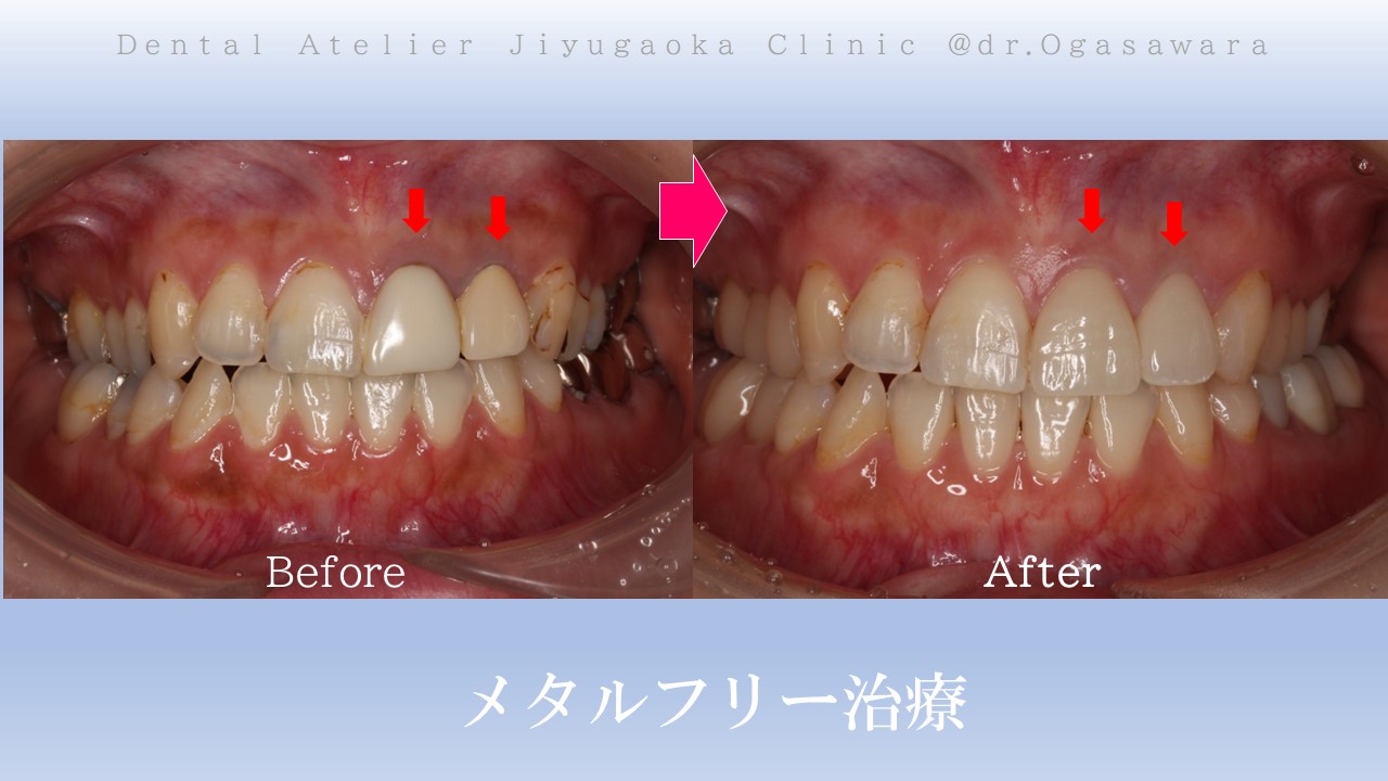 歯ぐきの黒ずみ　差し歯　銀歯　虫歯　セラミック　自由が丘　歯医者