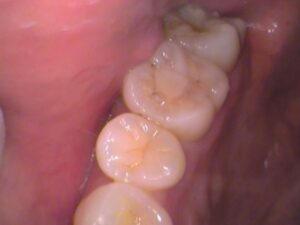 レジン　虫歯　セラミック治療　歯医者　自由が丘