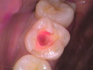 レジン　虫歯　セラミック治療　歯医者　自由が丘