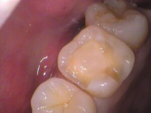 レジン　虫歯　セラミック治療　歯医者　自由が丘