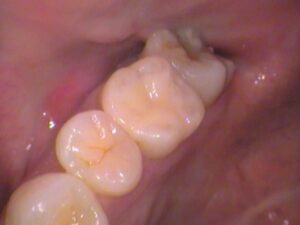 レジン　虫歯　セラミック治療　歯医者　自由が丘