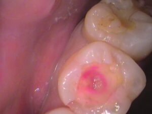 レジン　虫歯　セラミック治療　歯医者　自由が丘