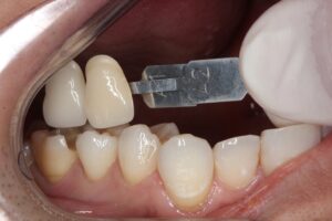 レジン　虫歯　セラミック治療　歯医者　自由が丘